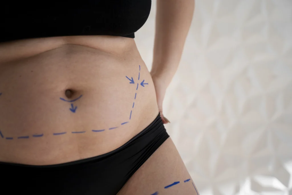 MESTRADO EM CIRURGIA PÓS-PARTO MOMMY MAKEOVER 2