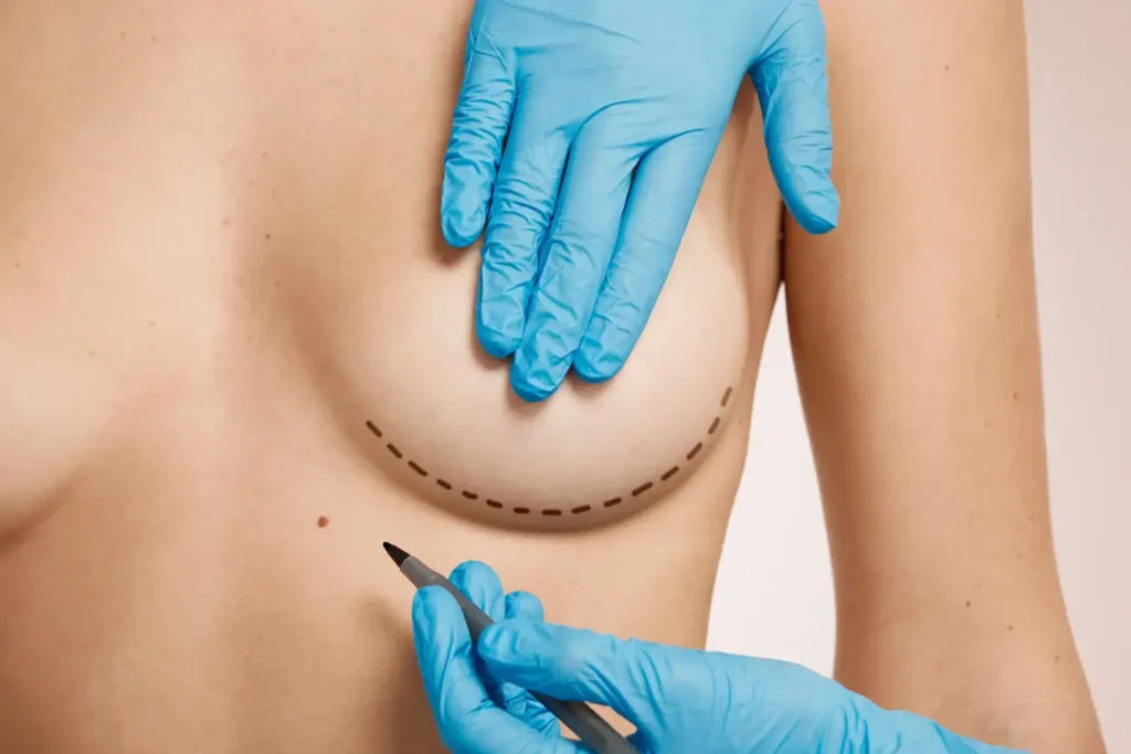 Mestrado em Cirurgia Estética Mamária 2