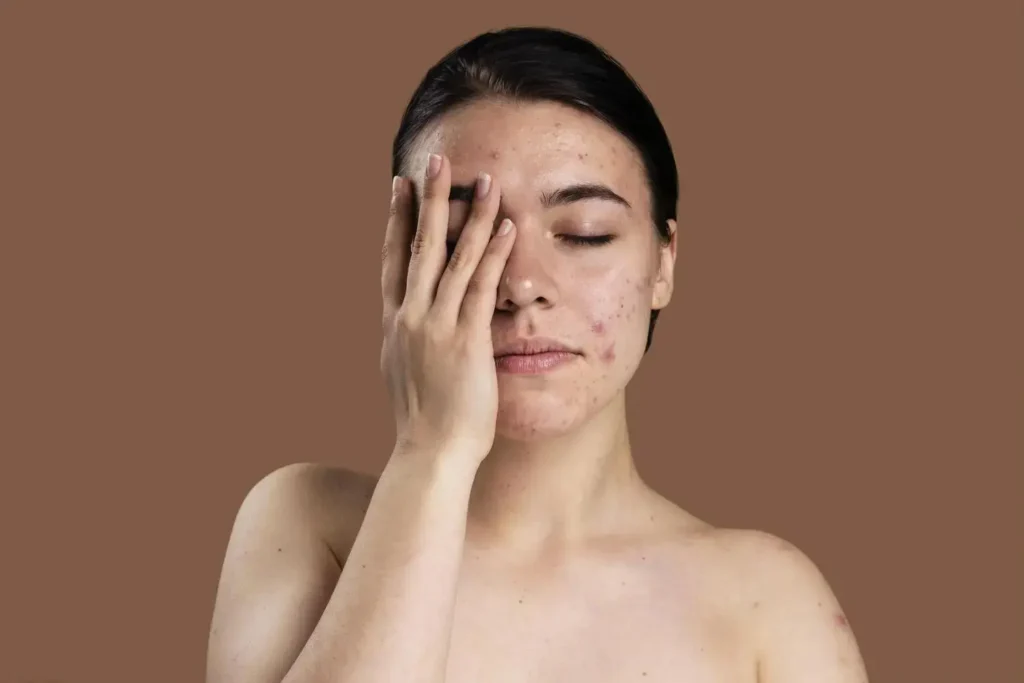Mestrado em Acne: Protocolos Clínicos, Cicatrizes e Abordagem Combinada 2