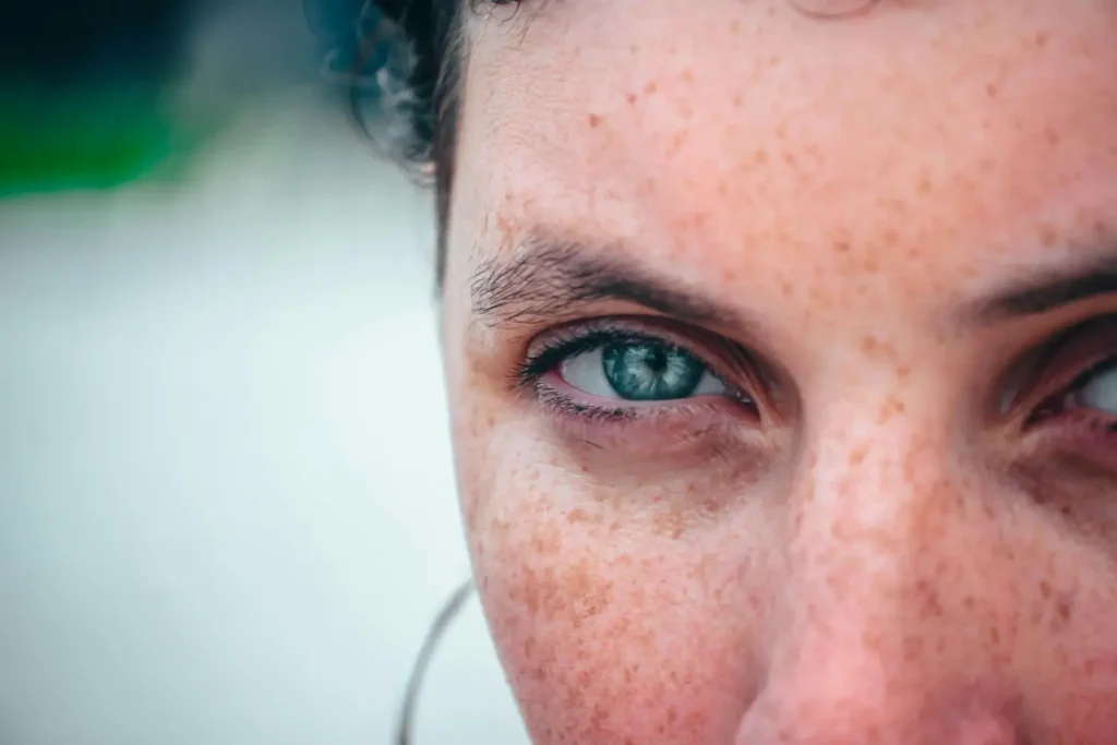 Mestrado em Cosmética para Hiperpigmentação e Melasma 3
