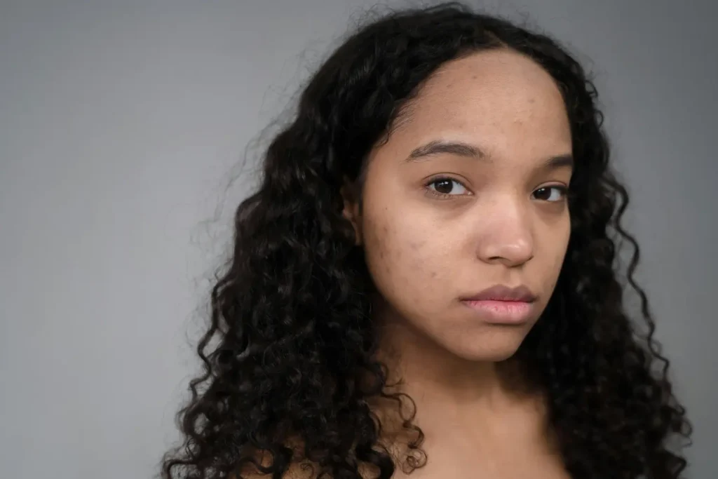Mestrado em Cosmética para Patologias — Acne, Rosácea e Dermatite 3