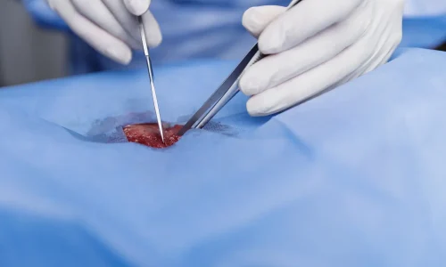 Curso de Especialista em Cirurgia a Laser de Próstata (HoLEP/ThuLEP) 1