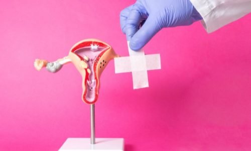 ISEIE-Master en estudios para Endometriosis