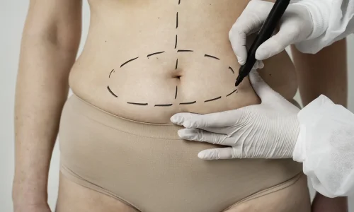 MESTRADO EM ABDOMINOPLASTIA E CIRURGIA PÓS-BARIÁTRICA 1