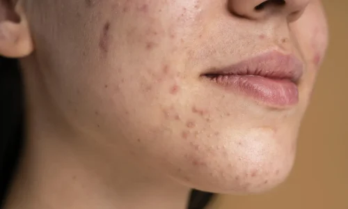 Mestrado em Acne: Protocolos Clínicos, Cicatrizes e Abordagem Combinada 1