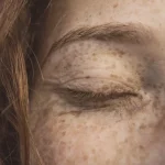 estrado em Hiperpigmentações, Melasma, PIH e Tratamentos Combinados 3
