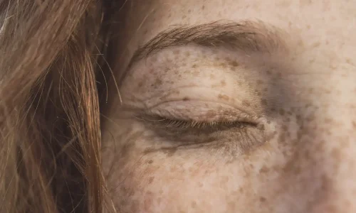 estrado em Hiperpigmentações, Melasma, PIH e Tratamentos Combinados 3