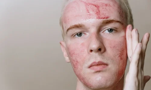 Mestrado em Dermatite Atópica e de Contato e seu Impacto Estético 1