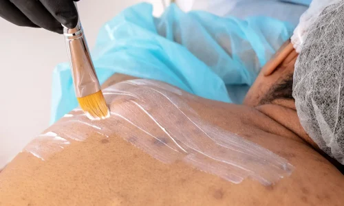 Mestrado em Peelings Médicos e Tratamentos Médicos Tópicos e Sistêmicos 1